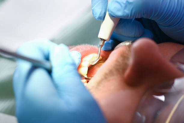 Best Emergency Dentist for Lost Fillings or Crowns in Hazel Dell, WA